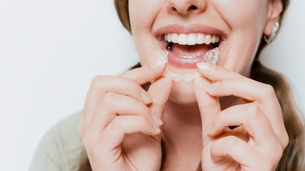aligner dents