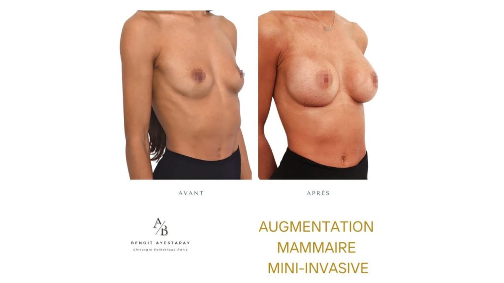 augmentation mammaire avant apres