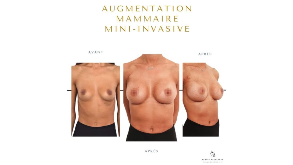 avant et apres augmentation poitrine