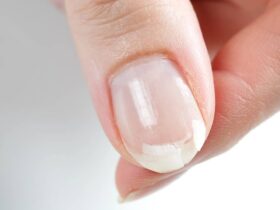 ongle casse que faire