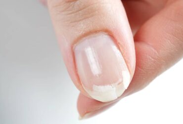ongle casse que faire