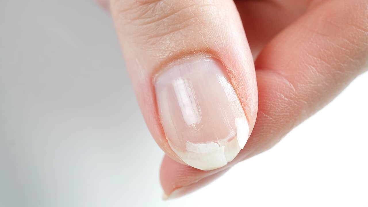 ongle casse que faire
