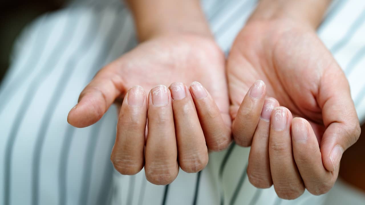 ongles fragiles apres manucure permanente