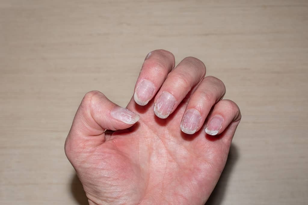 ongles fragiles